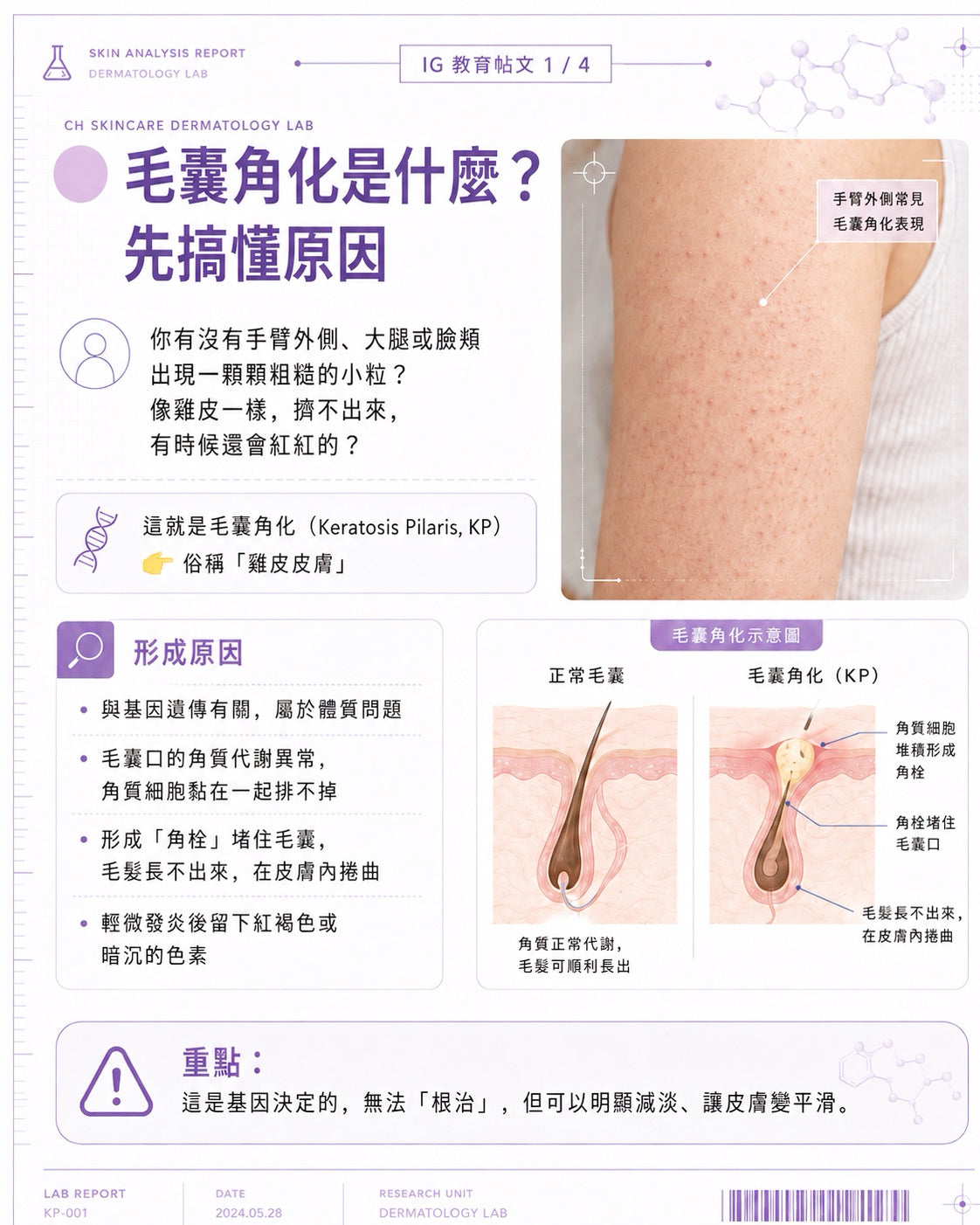 Keratinization laser
